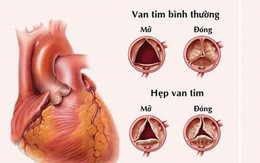 Người đàn ông ở Phú Thọ bị hỏng van tim, tự tin lên bàn mổ khi được bác sĩ áp dụng phương pháp ít xâm lấn