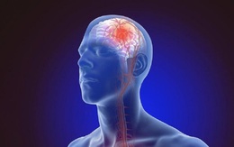 Người đàn ông 52 tuổi ở Hà Nội bị nhồi máu não bán cấp từ dấu hiệu nhiều người Việt bỏ qua