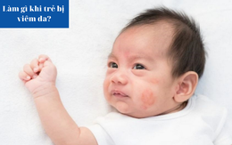 Làm gì khi trẻ bị viêm da?