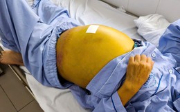 Người phụ nữ 61 tuổi suy gan nặng, nguy cơ tử vong cao do chủ quan với dấu hiệu này