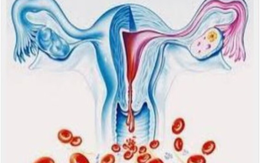 Bất ngờ 'thủ phạm' khiến người phụ nữ 40 tuổi bị rong kinh suốt 20 ngày
