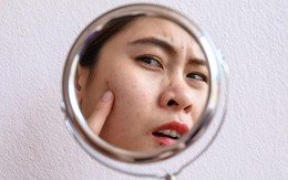 Hậu quả không thể cứu vãn từ thói quen nặn mụn