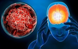 6 nhóm người nguy cơ đột quỵ cao, ai có dấu hiệu này cần cảnh giác!