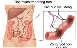 Phát hiện 'thủ phạm' gây tắc tĩnh mạch sau 7 lần mổ hoại tử ruột