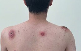Nam nhân viên văn phòng lở loét toàn thân vì quan hệ tình dục bừa bãi