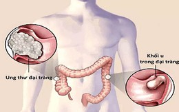 Dấu hiệu ung thư đại tràng bị nhiều người bỏ qua: Đầy hơi, đi ngoài phân nhỏ dẹt... đừng chủ quan