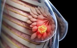 Không chỉ do di truyền: Ung thư vú đang gia tăng vì 5 thói quen này, bạn đã biết chưa?