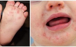 Bùng phát bệnh tay chân miệng ở trẻ: Cách phòng tránh cha mẹ không được bỏ qua!