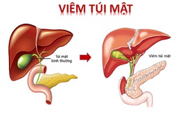 Người phụ nữ 44 tuổi ở Hà Nội bị viêm nhiễm, hoại tử gây thủng túi mật vì chủ quan bỏ qua dấu hiệu này