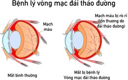 Nam thanh niên nguy cơ mù vĩnh viễn do sai lầm khi điều trị đái tháo đường nhiều người hay mắc phải