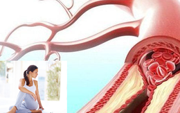 4 thay đổi lối sống hàng đầu giúp giảm nguy cơ tắc nghẽn động mạch