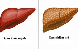 Gan nhiễm mỡ không chừa ai: 8 dấu hiệu sớm cảnh báo bạn đang đối diện nguy hiểm