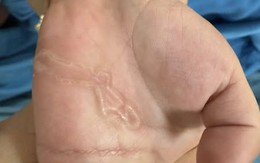 Nghịch cát, bé 4 tuổi bị nhiễm sán từ vết xước nhỏ ở kẽ ngón tay