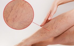 Suy giãn tĩnh mạch: Đừng mắc sai lầm để phải chấp nhận sống chung với bệnh