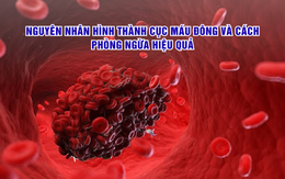 Nguyên nhân hình thành cục máu đông và cách phòng ngừa hiệu quả