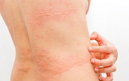 Đi mưa dầm, về mắc nấm da: Những vùng dễ bị ‘tấn công’ mà ai cũng bỏ qua