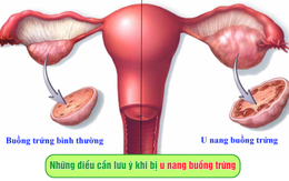 Những điều cần lưu ý khi bị u nang buồng trứng