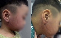 Bé 4 tuổi nghi bị giáo viên mầm non ở Hà Nội đánh bầm tím mặt