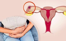 Người phụ nữ 42 tuổi suýt mất mạng do chủ quan khi bị đau bụng dưới âm ỉ, ra máu bất thường suốt 3 tuần