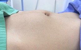 Đau bụng âm ỉ, bé gái 15 tuổi ở Quảng Ninh đi khám phát hiện mắc loại ung thư sinh dục hiếm gặp
