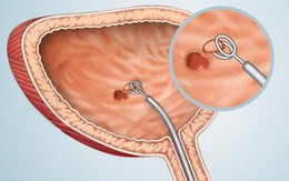 Sỏi bàng quang có nguy hiểm không? Những sự thật gây sốc về sỏi bàng quang