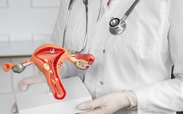 6 bệnh lý có thể phải phẫu thuật cắt bỏ tử cung