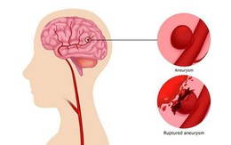 Xuất huyết não: Hiểm họa thầm lặng và cách phòng ngừa để bảo vệ não bộ