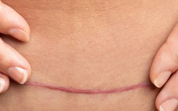 Để vết mổ sau sinh mau lành và không để lại sẹo
