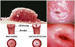 'Thủ phạm' gây ung thư cổ tử cung, chị em nhất định phải biết để phòng tránh