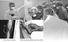 Chuyện lạ: Thai phụ được bác sĩ ghép tạm bàn tay vào cẳng chân chờ ngày nối lại