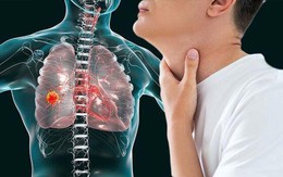 Người đàn ông 60 tuổi bất ngờ phát hiện ung thư phổi từ dấu hiệu nhiều người Việt mắc phải, nhưng đều bỏ qua