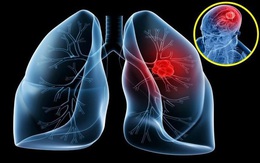 Không hút thuốc, người phụ nữ 53 tuổi bất ngờ phát hiện ung thư phổi từ dấu hiệu nhiều người Việt mắc phải