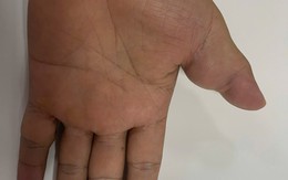 Người đàn ông mắc bệnh lý mạch máu hiếm gặp, khối u 17 năm ăn mòn xương ngón tay