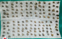 Kết quả bất ngờ: 130 viên sỏi chi chít được lấy ra từ túi mật của nữ bệnh nhân 40 tuổi