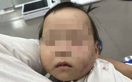 Bé gái 1 tuổi bị bầm tím mặt khi gửi nhà trẻ ở Bắc Ninh: Công an tạm giữ cô giáo