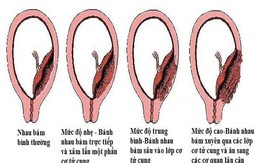 Thận trọng với nhau cài răng lược khi mang thai