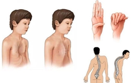 Không chỉ là dáng cao gầy, tay chân dài bất thường: Hội chứng Marfan tiềm ẩn biến chứng tim mạch gây tử vong