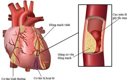 Người đàn ông 66 tuổi bị nhồi máu cơ tim cấp thừa nhận chủ quan với dấu hiệu cảnh báo sớm
