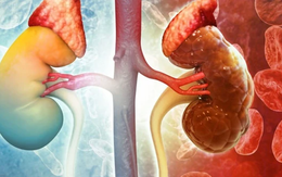 Thanh niên 30 tuổi đang khỏe mạnh sững sờ phát hiện suy thận: 'Tôi không hề đau, không mệt, sinh hoạt bình thường'