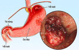 Áp lực mùa thi, nam sinh 15 tuổi hai lần nhập viện vì loét dạ dày