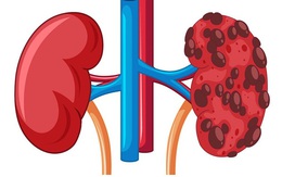Căn bệnh khiến người đàn ông 55 tuổi rơi vào suy thận giai đoạn cuối nguy hiểm thế nào?