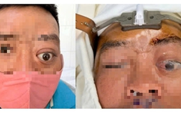 Một ca bệnh mà Bệnh viện Tai Mũi Họng TPHCM mới gặp lại trong vòng 20 năm