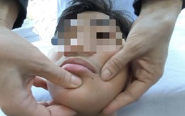 Miền Bắc rét đột ngột, gia tăng số người bị méo miệng