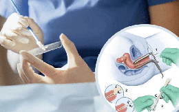 Khi nào nên làm xét nghiệm Pap để sàng lọc ung thư cổ tử cung?