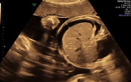 Chọc hút dịch màng bụng thai nhi dưới siêu âm: Can thiệp kịp thời, nuôi dưỡng sự sống cho thai nhi