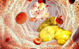 Thanh niên 24 tuổi mắc rối loạn chuyển hóa nặng thừa nhận 1 sai lầm nhiều người Việt mắc phải