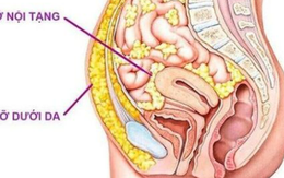 6 điều bạn nên làm để giảm mỡ nội tạng hiệu quả, bền vững