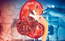 8 thói quen gây suy thận, người Việt cần biết để tránh