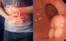 Chỉ nghĩ bị viêm đường tiêu hóa, nam sinh 17 tuổi đi khám phát hiện ung thư dạ dày: Có dấu hiệu này không nên chủ quan