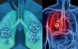 Người đàn ông 68 tuổi phát hiện ung thư phổi di căn từ những dấu hiệu người Việt dễ bỏ qua